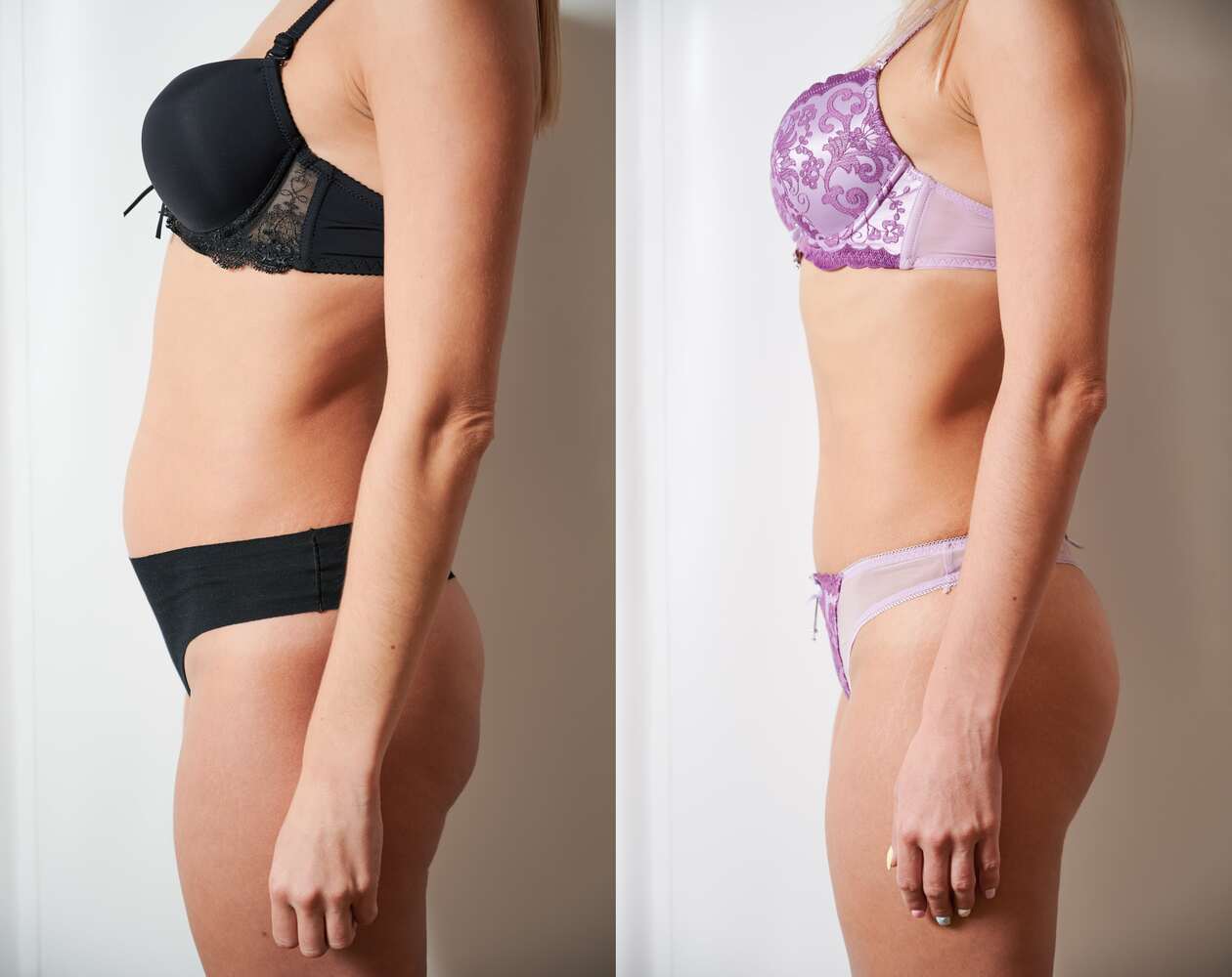 side-view-woman-s-body-before-after-weight-loss-plastic-surgery-concept-min(1) (1)